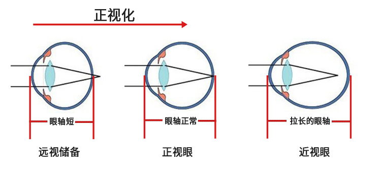 眼睛正视化，近视过程.jpg
